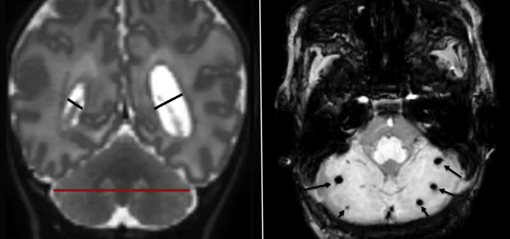 Two Early Risk Factors Point to Higher Autism Risk in Very Preterm Infants