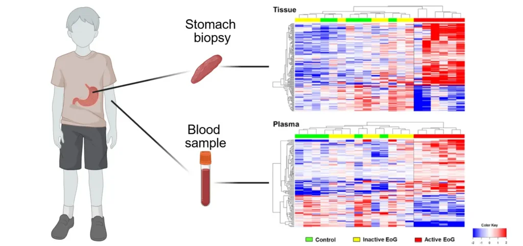 Study Reveals Blood Markers Tied to Eosinophilic Gastritis Disease Activity