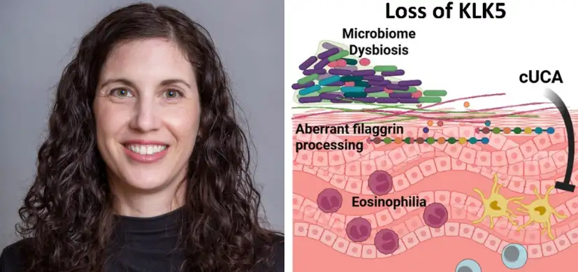 What KLK5 Taught Me About Atopic Dermatitis