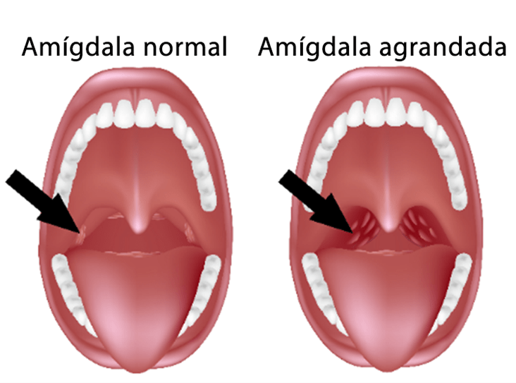 Illustration of the tonsils.