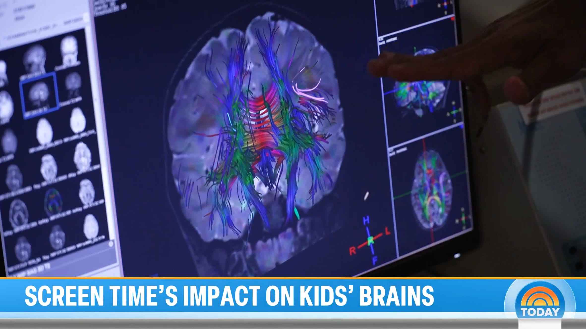 Screenshot of Cincinnati Children's on the Today Show.