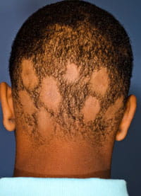 Alopecia areata. Alopecia areata.