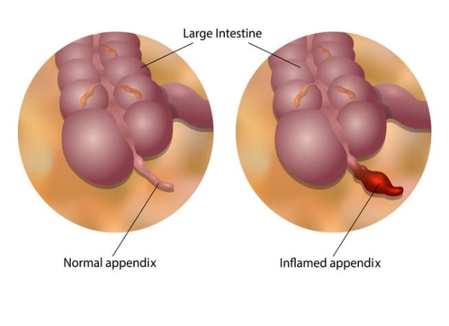 appendix pain in children