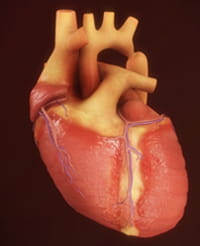 Coarctation of the aorta.