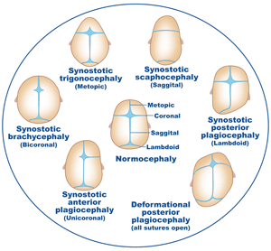 Types of craniosynostosis.