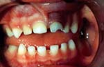 Oral injuries like this one can be avoided.