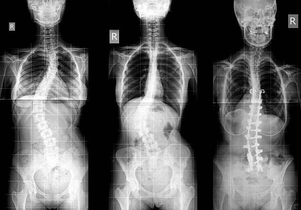 mild scoliosis x ray