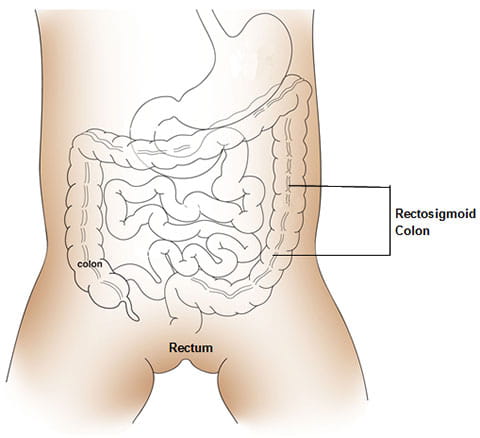 Rectosigmoid colon image.