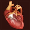 Hypoplastic left heart syndrome