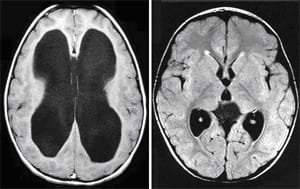 Hydrocephalus (left) and normal brain (right).