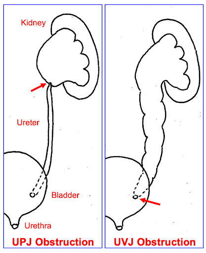 Shows two possible areas of obstruction in the urinary tract that may lead to hydronephrosis.