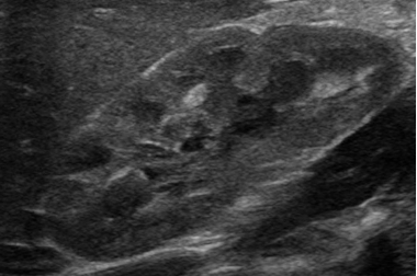 Ultrasound of a normal kidney