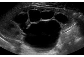 severe hydronephrosis kidney
