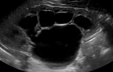 severe hydronephrosis kidney