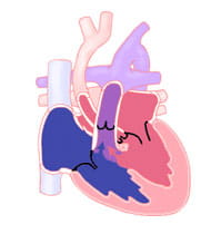 Interrupted aortic arch.