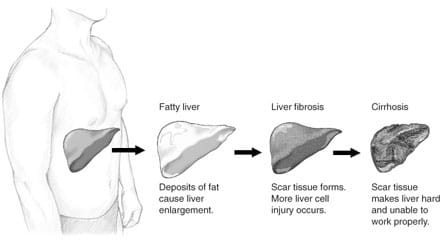 Fatty Liver Disease