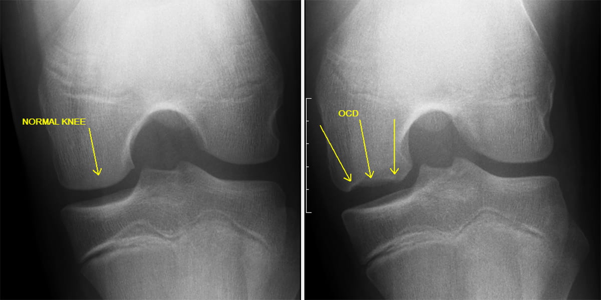 This is a photo of Osteochondritis Dissecans