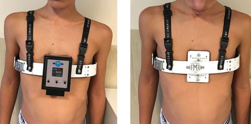 A photo of a pectus carinatum brace.