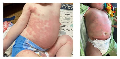 Rash evolves: SSLR may look like hives but turn purple after that. This is not dangerous.