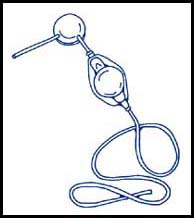 Simple Shunts Shunts | Treatments & Procedures