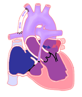 Single ventricle anomalies illustration.