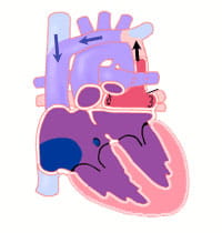 Total anomalous pulmonary venous return.