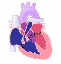 Tetralogy of Fallot.