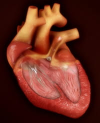 Tetralogy of Fallot.