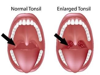 An illustration of normal tonsils versus enlarged tonsils.