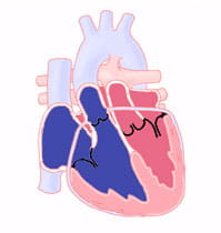 Transposition of the Great Arteries