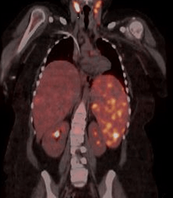 A PET scan image from a lymphoma and HLH patient.