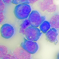 Leukemia cells used to identify potential treatment targets for acute myeloid leukemia (AML).