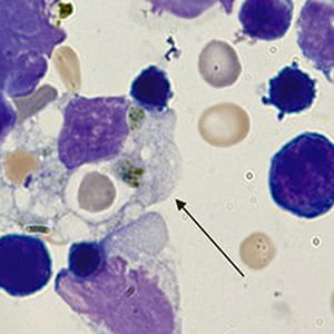 An image showing macrophage immune cells flooding healthy tissue cells.