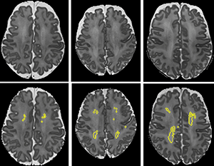 An image of MRI scans showing diffuse white matter abnormality (DWMA).