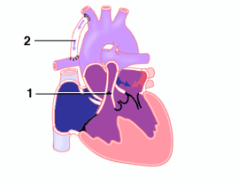 Tricuspid Atresia, small VSD