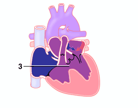 Tricuspid Atresia, medium VSD