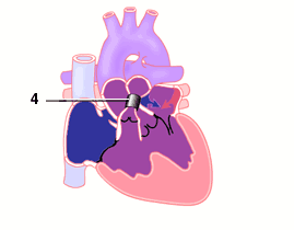 Tricuspid Atresia, large VSD