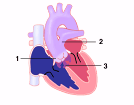 truncus_1_2