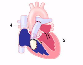 truncus_2_2