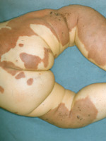 Illustration 1: Capillary malformation (portwine stains)