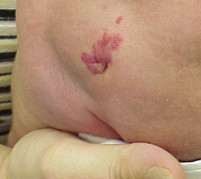 Illustration 6 Hemangioma on Lower Back