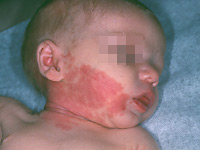 Illustration 2: Facial capillary malformation