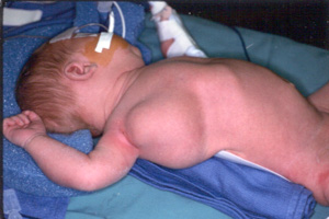 Illustration 2: Lymphatic Malformation in Axilla (armpit)