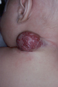 Illustration 4 Neck Hemangioma