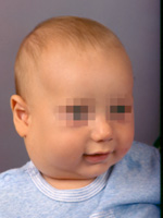 Illustration 3: Small Neck Lymphatic Malformation