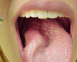 Illustrations 2: Venous Malformations