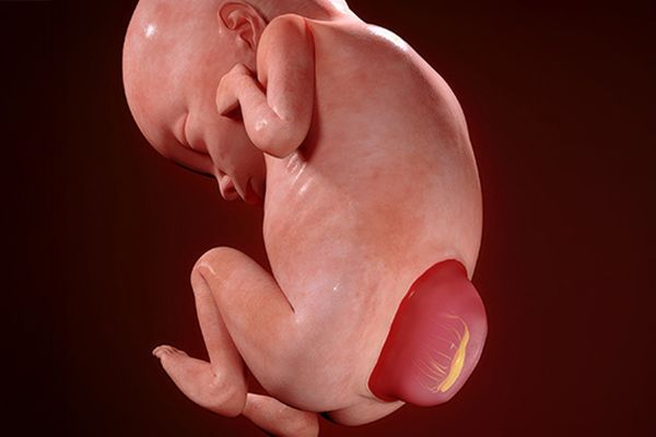 Illustration of myelomeningocele.