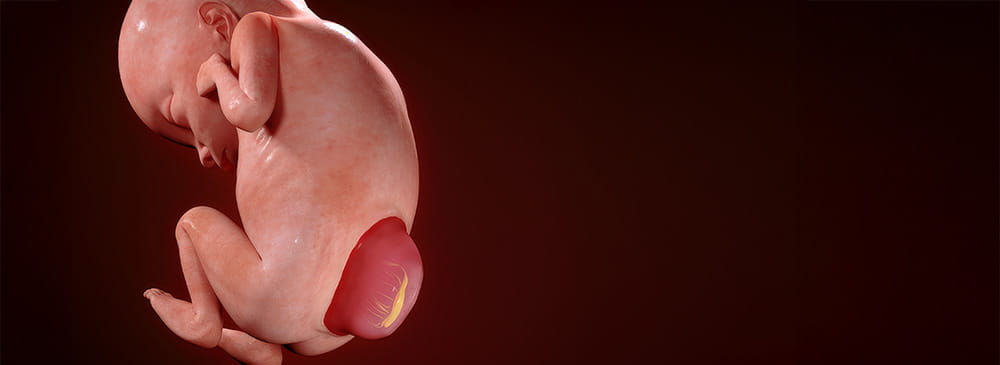 Illustration of myelomeningocele.