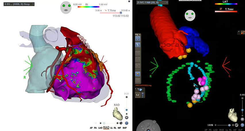 CT scan and pre-procedural mapping.