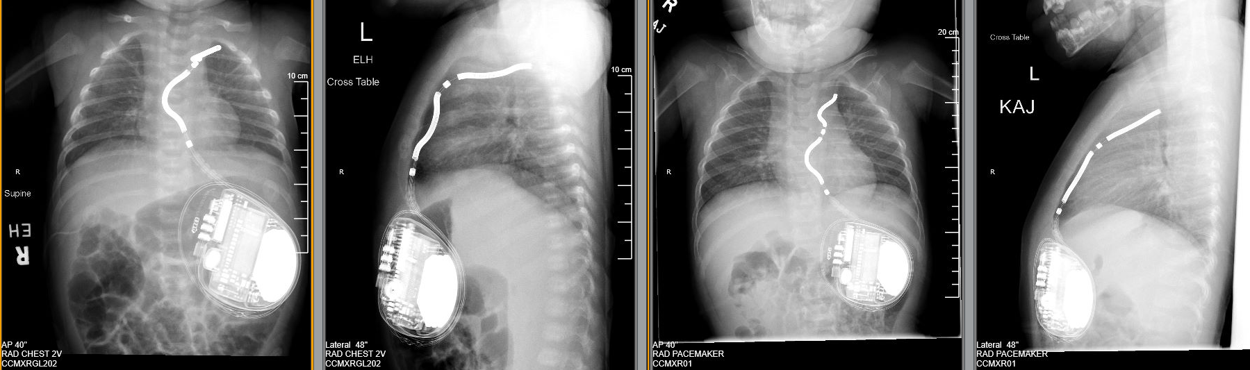 X-rays showing EV‑ICD system positioning from initial implantation through 10.5‑month follow‑up.